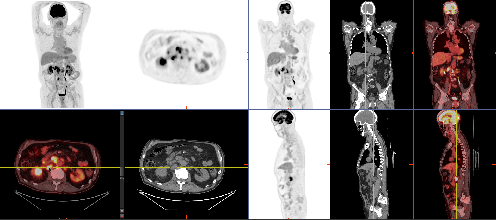 PET Scans for Rare & Uncommon Cancers – Are You Referring Eligible Patients?
